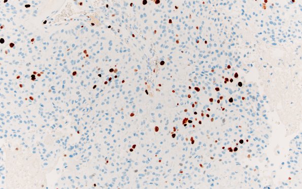 2G Astroblastoma, recurrent (Case 2) Ki67 1