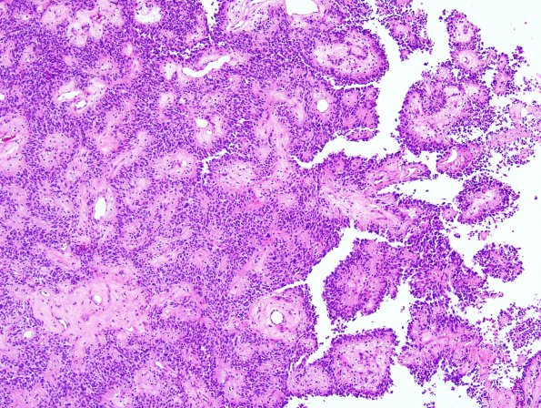 3A1 Astroblastoma (Case 3) 1.jpg