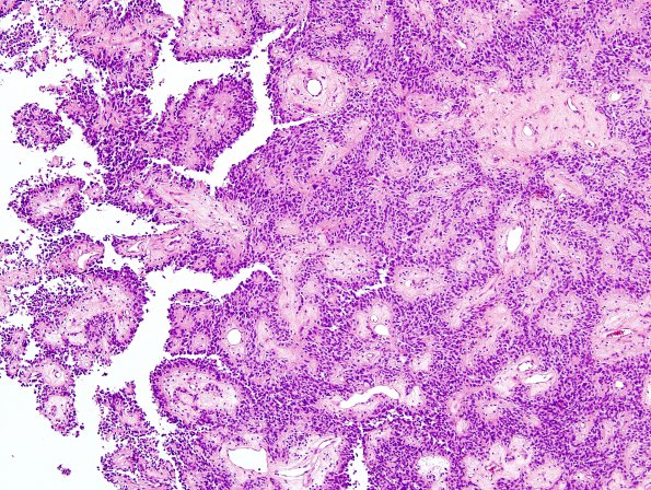 3A2 Astroblastoma, focal anaplasia (Case 3) H&E 5.jpg