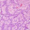 3A3 Astroblastoma, focal anaplasia (Case 3) H&E area A 20X.jpg