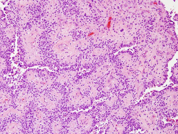 3A3 Astroblastoma, focal anaplasia (Case 3) H&E area A 20X.jpg