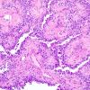 3A4 Astroblastoma (Case 3) 2.jpg