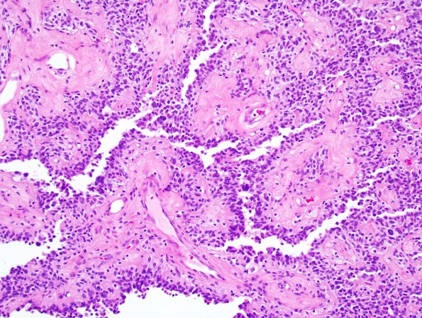 3A4 Astroblastoma (Case 3) 2.jpg