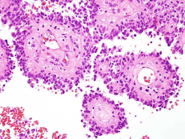 3A5 Astroblastoma (Case 3) H&E 1