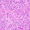 3A6 Astroblastoma (Case 3) 7.jpg