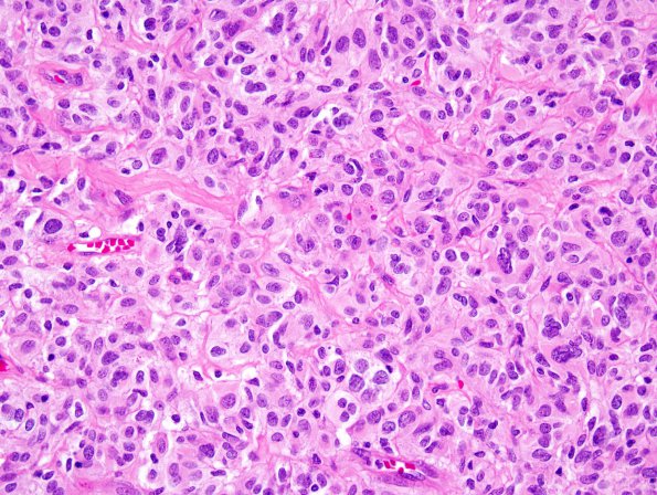 3A6 Astroblastoma (Case 3) 7.jpg