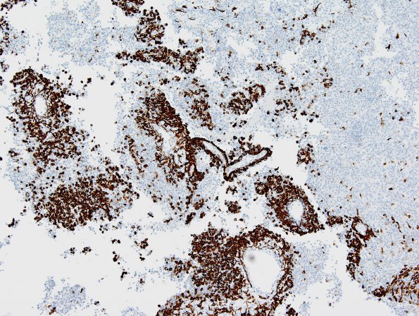 3B1 Astroblastoma, focal anaplasia (Case 3) GFAP 5.jpg