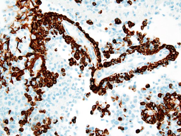 3B2 Astroblastoma (Case 3) GFAP 4.jpg