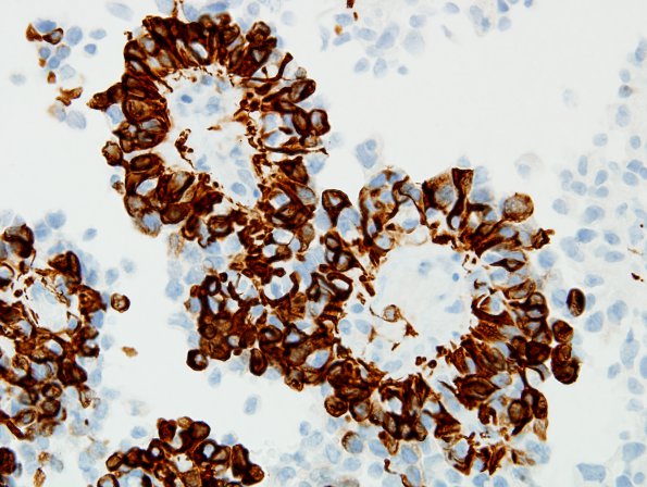 3B3 Astroblastoma, focal anaplasia (Case 3) GFAP 1.jpg