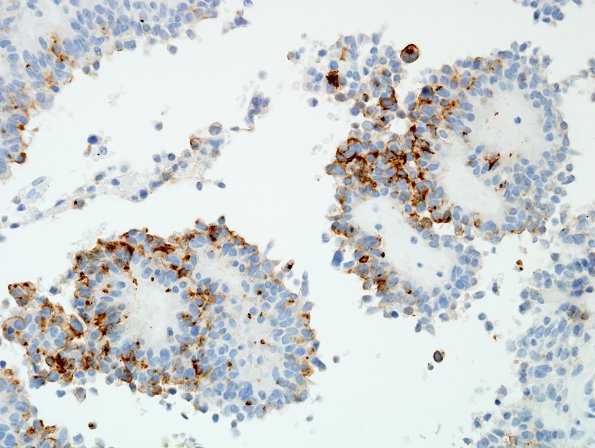 3C2 Astroblastoma, focal anaplasia (Case 3) EMA 2.jpg