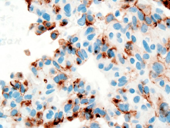 3C3 Astroblastoma (Case 3) EMA 4.jpg