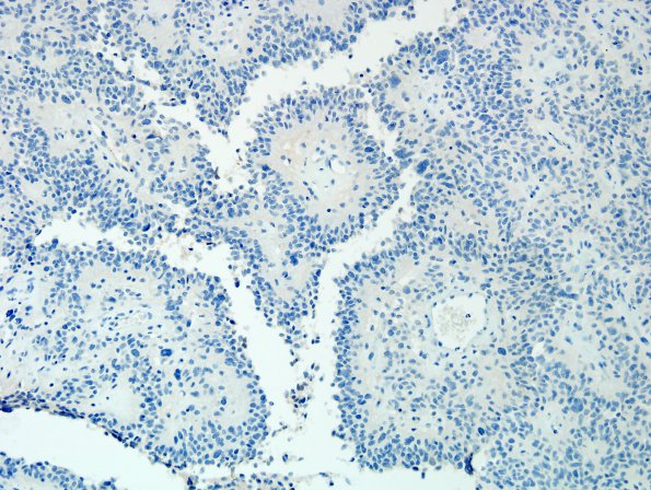 3D Astroblastoma, focal anaplasia (Case 3) NF.jpg