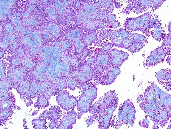 3E1 Astroblastoma (Case 3) Trichrome 2.jpg