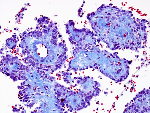 3E3 Astroblastoma, focal anaplasia (Case 3) Tri 5.jpg