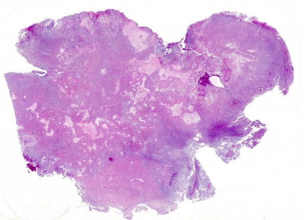 4A1 Astroblastoma, focal anaplasia (Case 4) 1 H&E WM