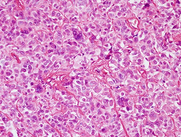 4A2 Astroblastoma, focal anaplasia (Case 4) H&E 7.jpg