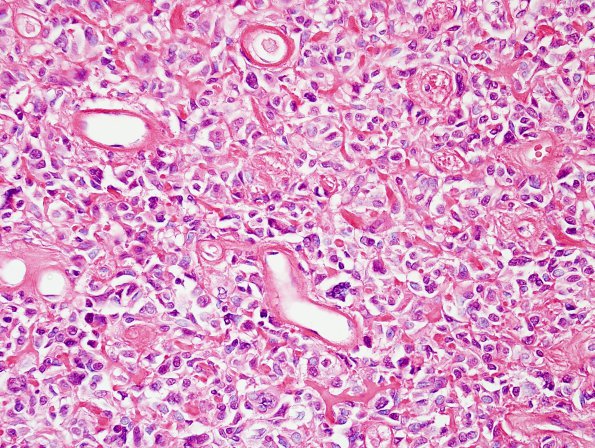 4A3 Astroblastoma, focal anaplasia (Case 4) H&E 3.jpg