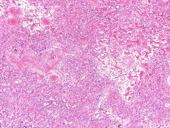 4A4 Astroblastoma, focal anaplasia (Case 4) H&E 8.jpg