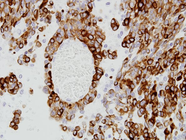 4B3 Astroblastoma, focal anaplasia (Case 4) GFAP 6.jpg