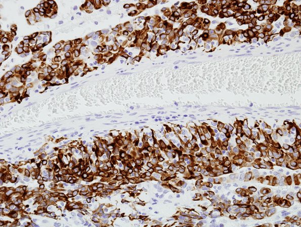 4B4 Astroblastoma, focal anaplasia (Case 4) GFAP 7.jpg