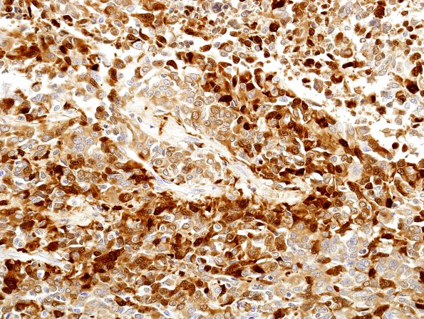 4C Astroblastoma, focal anaplasia (Case 4) S100 4.jpg