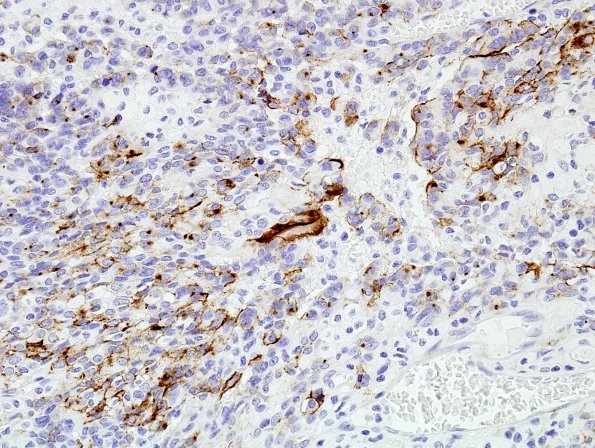 4D3 Astroblastoma, focal anaplasia (Case 4) EMA 9.jpg