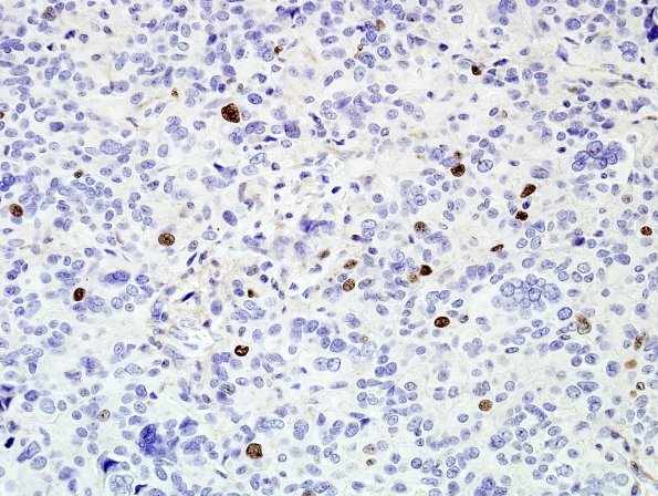 4E2 Astroblastoma, focal anaplasia (Case 4) Ki67 1.jpg