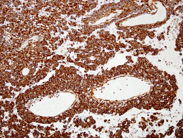 4F1 Astroblastoma, focal anaplasia (Case 4) VIM 1.jpg