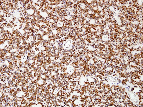 4F2 Astroblastoma, focal anaplasia (Case 4) VIM 3.jpg