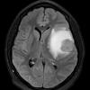 5A1 Astroblastoma, anaplastic (Case 5) FLAIR 2 - Copy