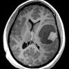 5A2 Astroblastoma, anaplastic (Case 5) T1 W 1 - Copy