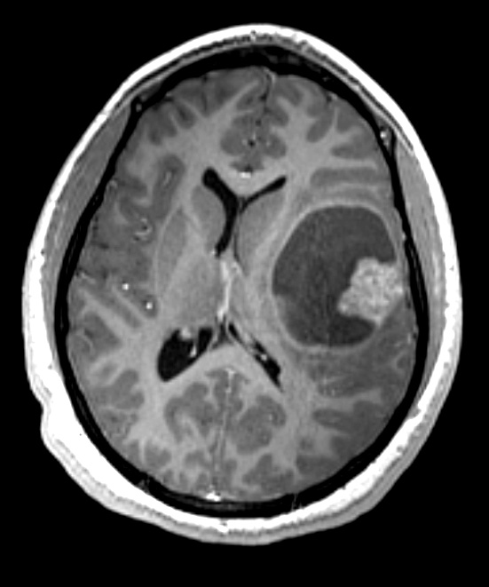 5A2 Astroblastoma, anaplastic (Case 5) T1 W 1 - Copy