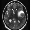 5A3 Astroblastoma, anaplastic (Case 5) T2 2 - Copy