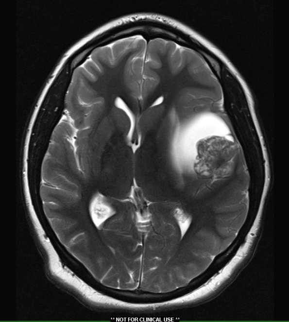 5A3 Astroblastoma, anaplastic (Case 5) T2 2 - Copy