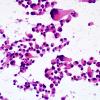 5B1 Astroblastoma, anaplastic (Case 5) smear H&E 3