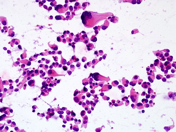 5B1 Astroblastoma, anaplastic (Case 5) smear H&E 3