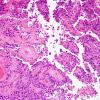 5B2 Astroblastoma, anaplastic (Case 5) H&E 18.jpg