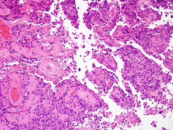 5B2 Astroblastoma, anaplastic (Case 5) H&E 18.jpg