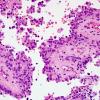 5B3 Astroblastoma, anaplastic (Case 5) H&E 3.jpg