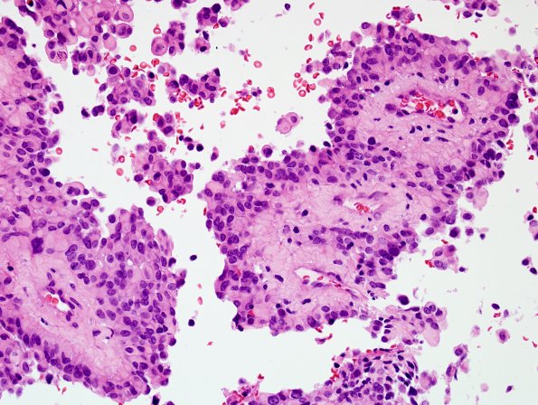 5B3 Astroblastoma, anaplastic (Case 5) H&E 3.jpg