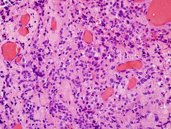 5B4 Astroblastoma, anaplastic (Case 5) H&E 1.jpg