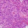 5B5 Astroblastoma, anaplastic (Case 5) H&E 4.jpg