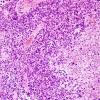  5B6 Astroblastoma, anaplastic (Case 5) H&E 16.jpg