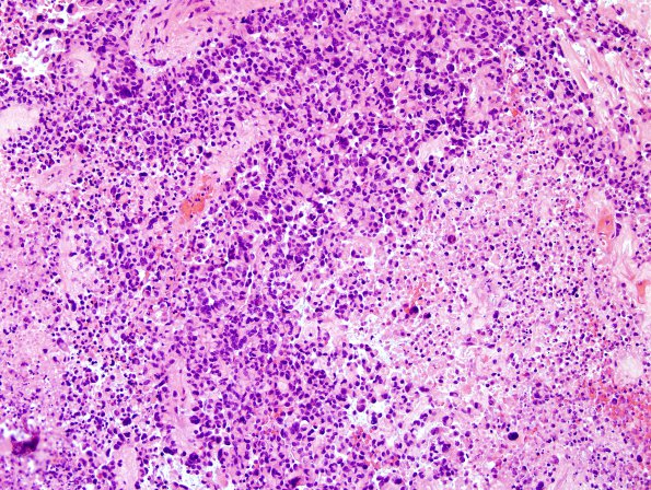  5B6 Astroblastoma, anaplastic (Case 5) H&E 16.jpg