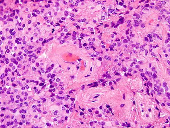 5B7 Astroblastoma, anaplastic (Case 5) H&E 21.jpg