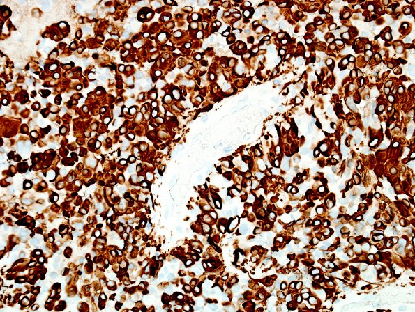 5C1 Astroblastoma, anaplastic (Case 5) GFAP 2.jpg