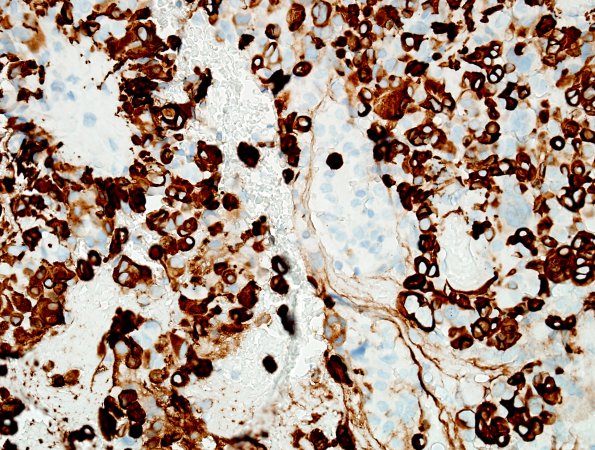 5C2 Astroblastoma, anaplastic (Case 5) GFAP 12.jpg