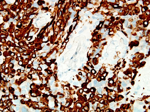 5C3 Astroblastoma, anaplastic (Case 5) GFAP 9.jpg