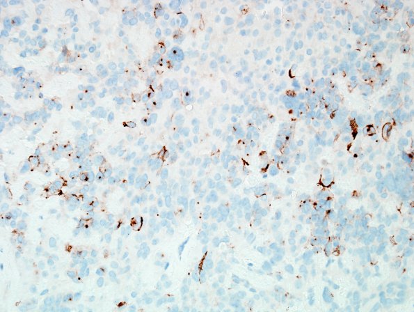 5D1 Astroblastoma, anaplastic (Case 5) EMA 1.jpg