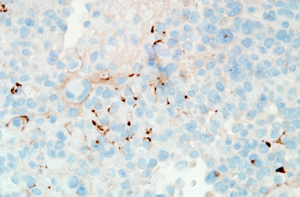 5D2 Astroblastoma, anaplastic (Case 5) EMA 2.jpg